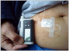 二型糖尿病15年病史_佩戴丹纳胰岛素泵远离并发症