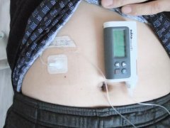 二型糖尿病2年病史_戴丹纳胰岛素泵可以提高生活质量！