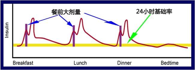 胰岛素泵剂量调剂