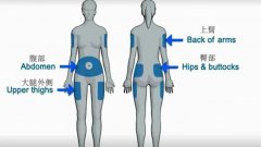 <b>丹纳胰岛素泵选择植入部位注意事项?</b>