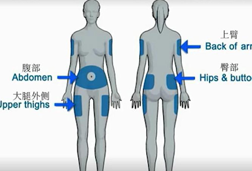 丹纳胰岛素泵选择植入部位注意事项?