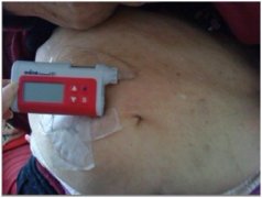 二型糖尿病8年病程_佩戴丹纳胰岛素泵控制好并发症