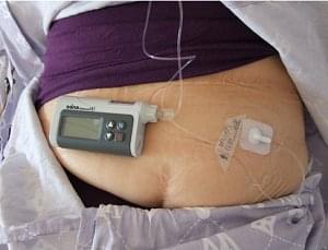 1型糖尿病12年，可以戴胰岛素泵吗？