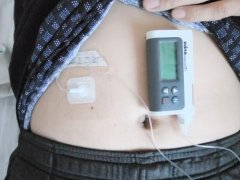 与皮下注射相比，胰岛素泵治疗二型糖尿病效果更好